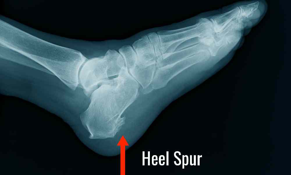 درمان خار پاشنه