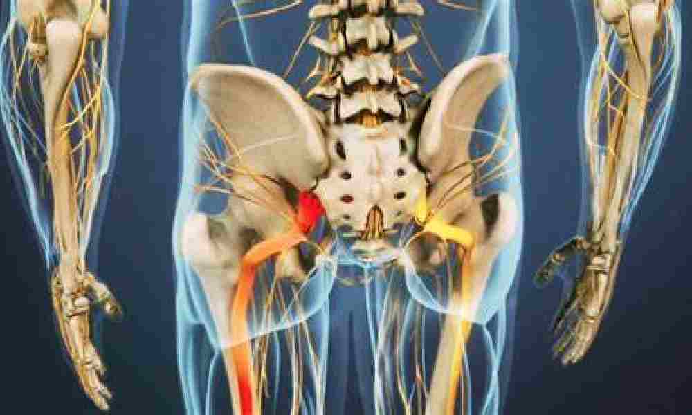 ماساژ درمانی برای بهبود سیاتیک