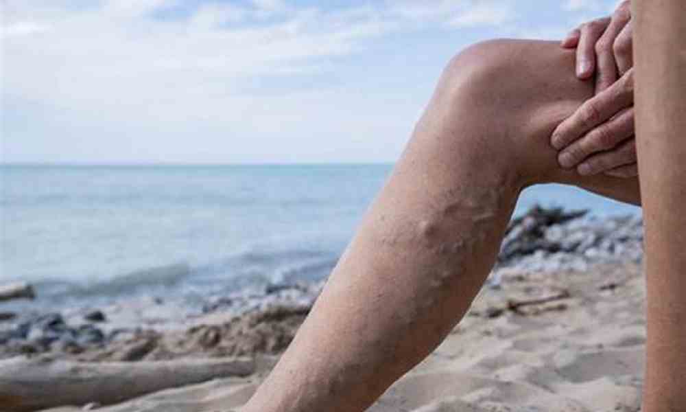 درمان واریس با فیزیوتراپی