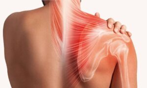 درمان افتادگی شانه با فیزیوتراپی