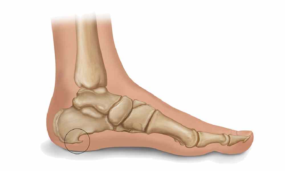 درمان خار پاشنه