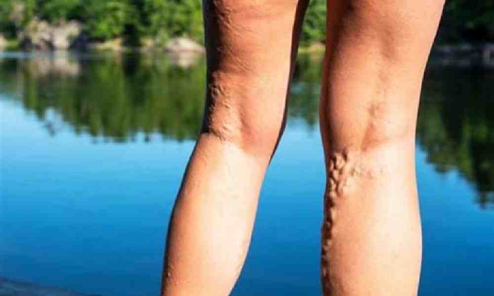 درمان واریس با فیزیوتراپی