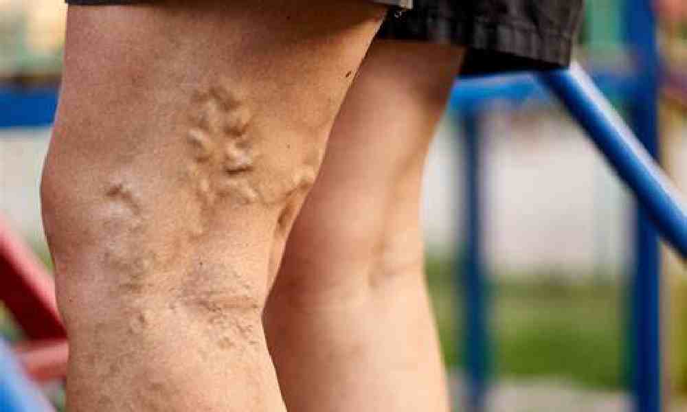 درمان واریس با فیزیوتراپی