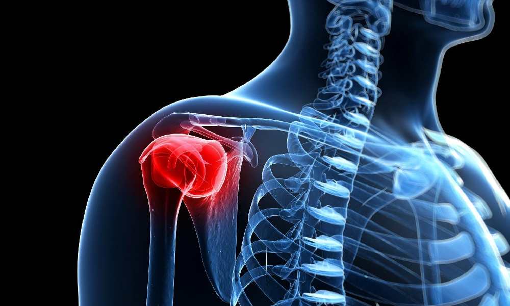 فیزیوتراپی شانه یخ زده