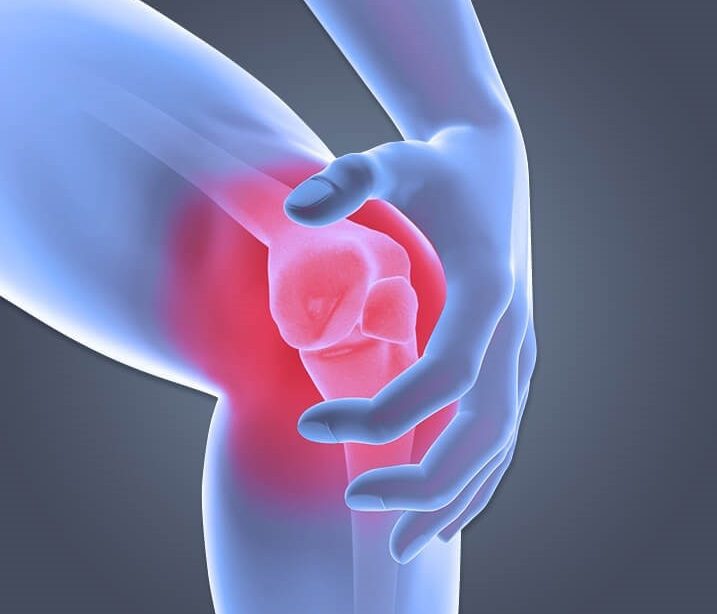 درمان آرتروز کشکک زانو