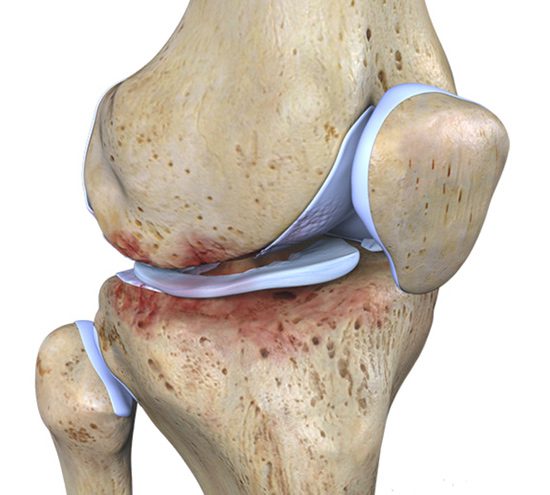 درمان آرتروز کشکک زانو