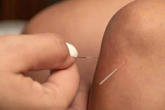 طب سوزنی برای زانو درد