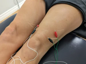 طب سوزنی برای زانو درد