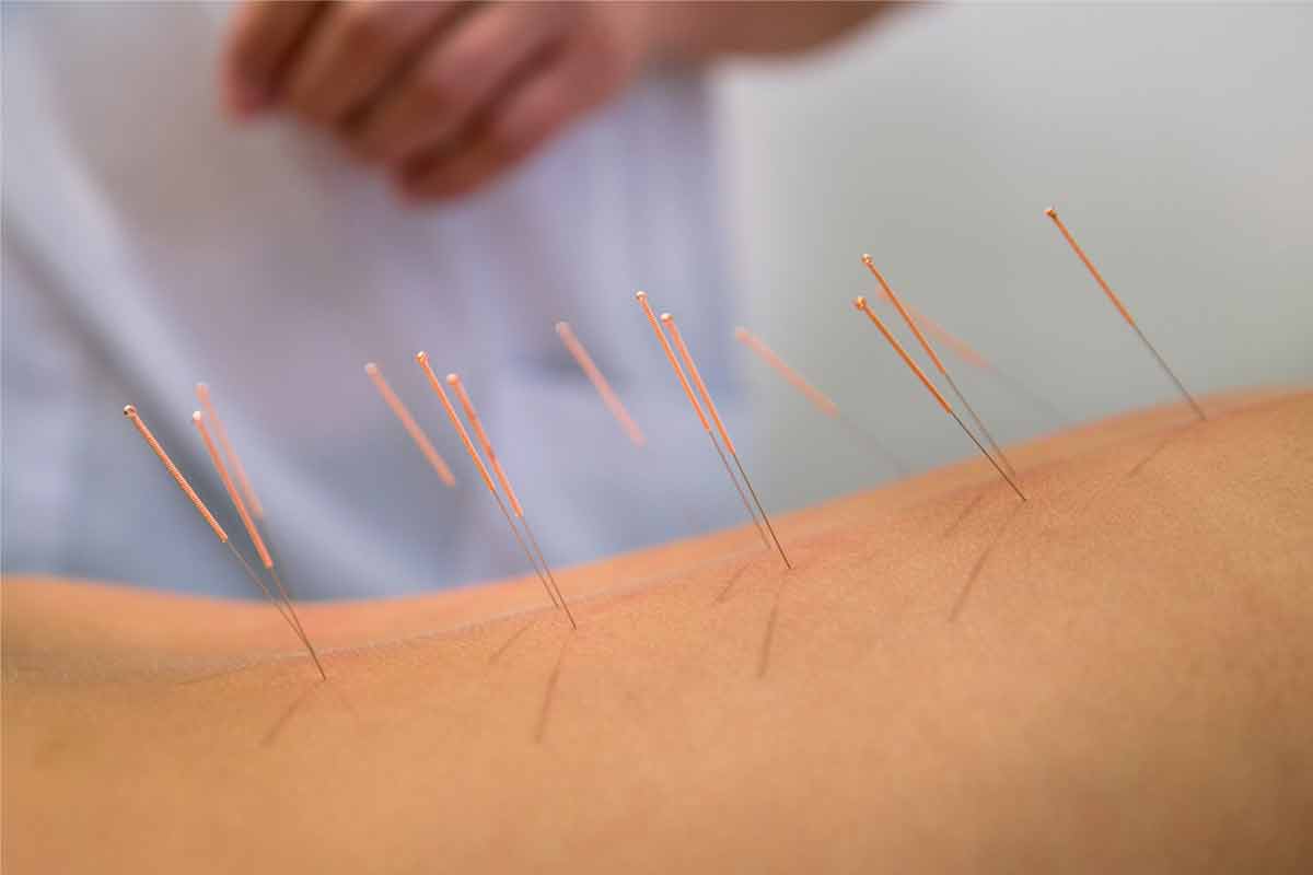 طب سوزنی درد