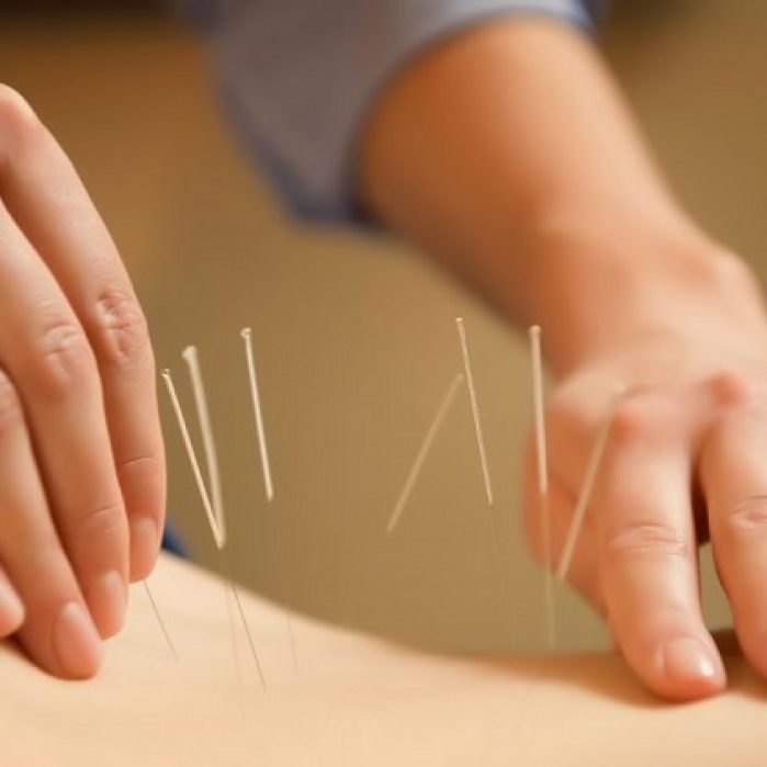 طب سوزنی لاغری