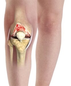 درمان آرتروز کشکک زانو