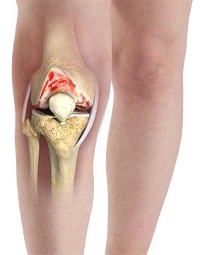 درمان آرتروز کشکک زانو