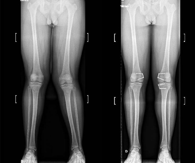 آرتروز زانو پای پرانتزی