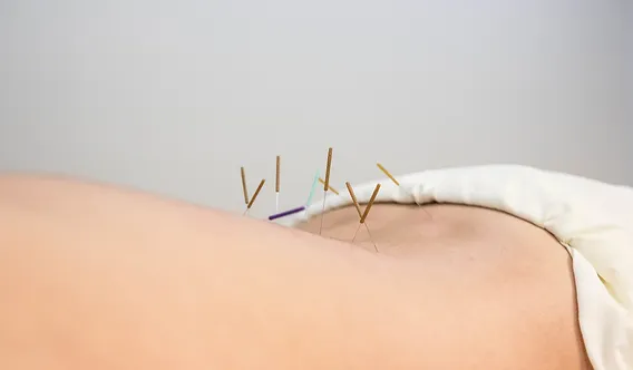 طب سوزنی برای سیاتیک