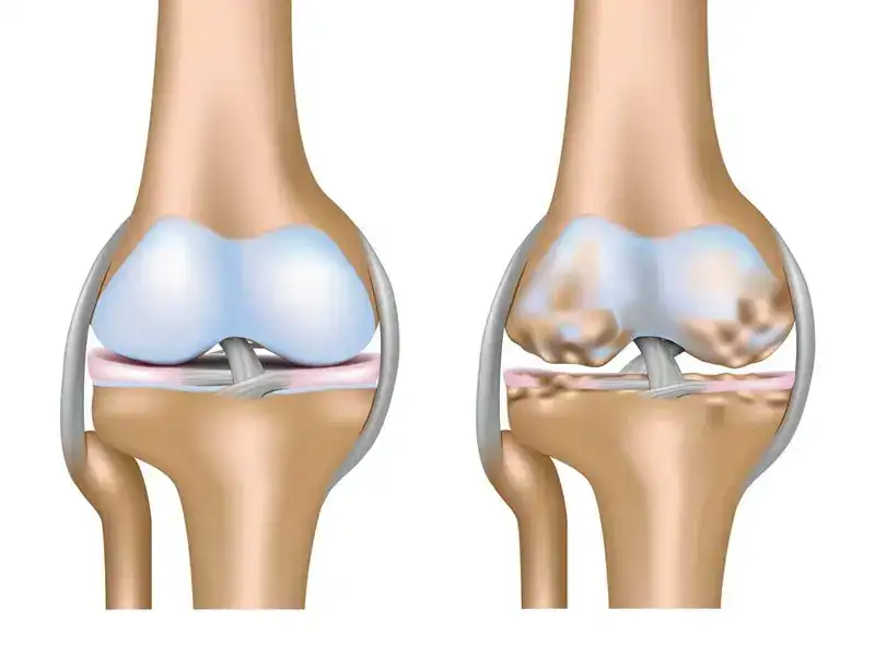 درمان آرتروز کشکک زانو