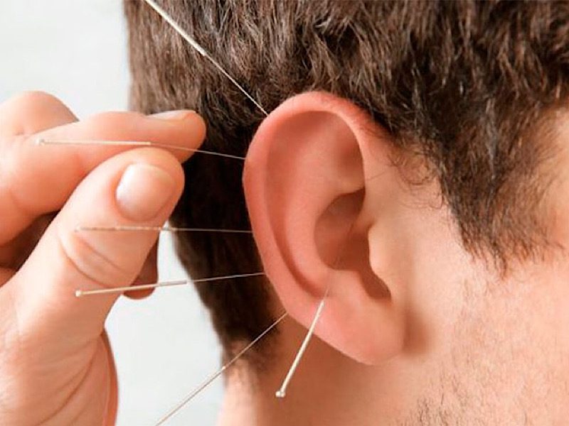طب سوزنی گوش