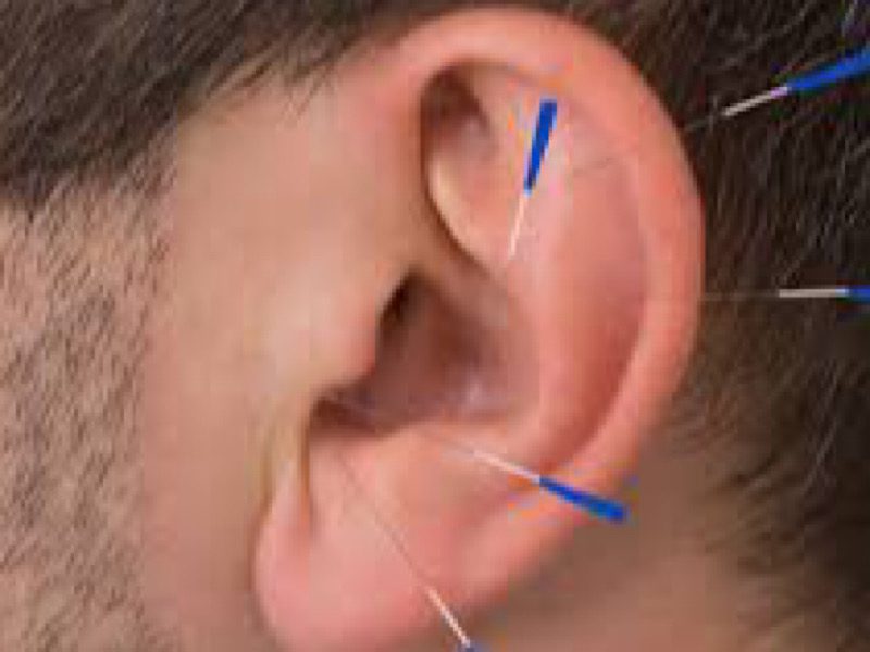 طب سوزنی گوش