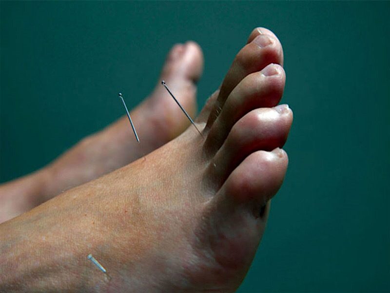 طب سوزنی پا و فواید آن