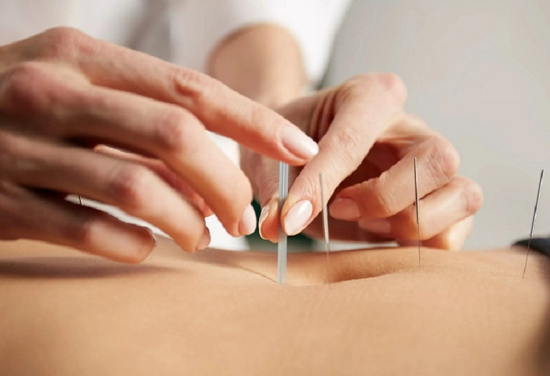 طب سوزنی حرفه ای در تهران