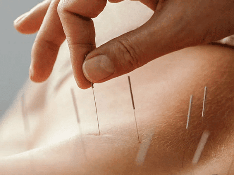 فواید طب سوزنی