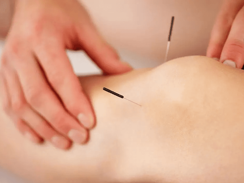 طب سوزنی تهران